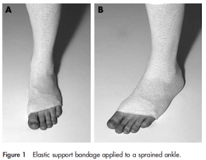 Elastic support bandage applied to a sprained ankle.