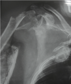 Fig. 1 – Radiograph of the right shoulder, showing a complex fracture of the proximal humerus with intrathoracic migration of the humeral head.