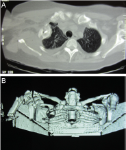 Fig. 2 – (A) Chest computed tomography (CT): axial section showing the humeral head in direct contact with the pulmonary parenchyma; (B) chest CT: 3D reconstruction. Rib fractures and cephalic migration into the pulmonary cavity are observed.